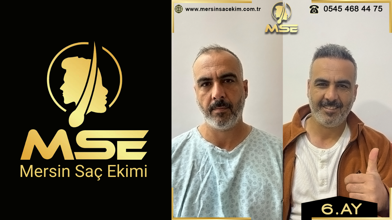 Mersin Saç Ekimi